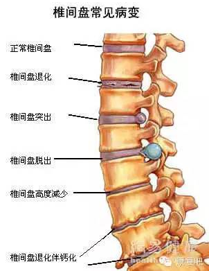 椎間盤(pán)常見(jiàn)病變