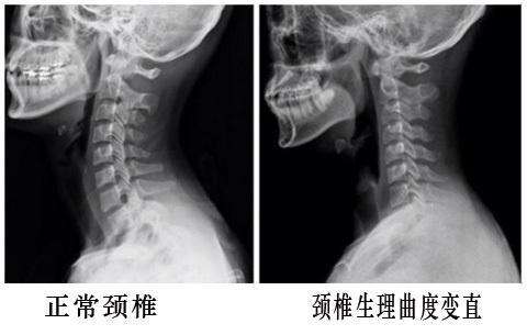 頸椎曲度變直