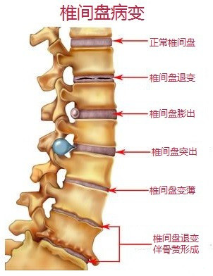 椎間盤(pán)病變