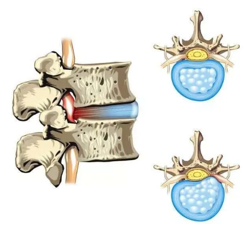 椎間盤(pán)解剖